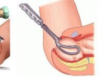 Methods-Of-Abortion