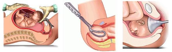 Methods-Of-Abortion