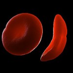 Red Blood Cells: Normal and Sickle shaped